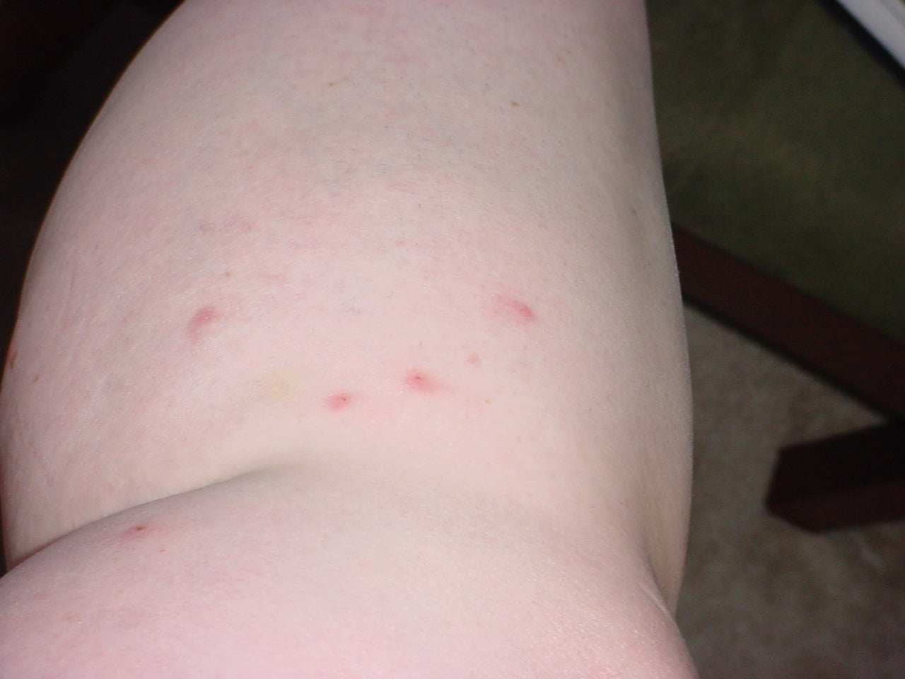 Bed bug bite