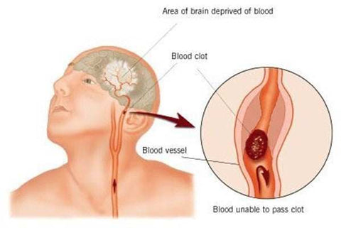 blood clot signs