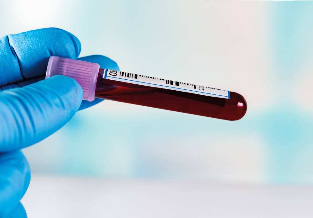 hand-holding-blood-sample-tube-bank-Hyperproteinemia-definition-cause-symptoms-treatment-welzo-blood-test