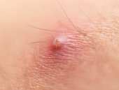 Vaginal Boils are pus filled swellings