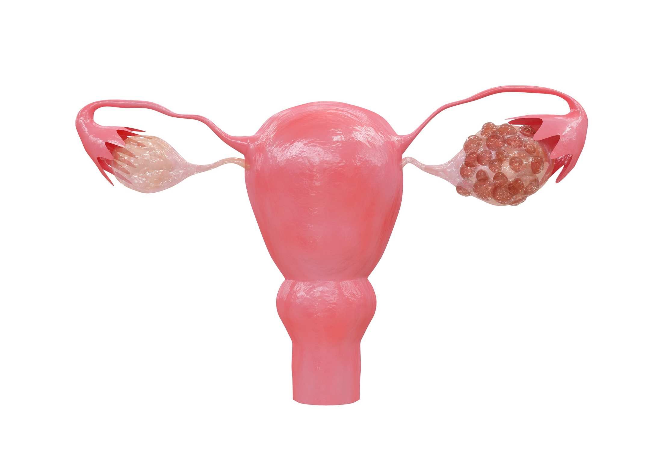 Polycystic Ovary Syndrome