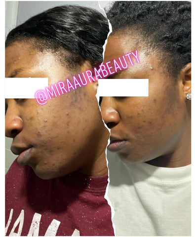 Acne face mask, acne treament, acne set, acne, dark spot, dark spot remover, dark patches