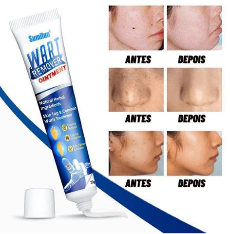 Removedor de Verrugas kelby boutique removedor de verrugas instantaneo melhor removedor de verrugasremovedor de verrugas no rosto gel removedor de verrugas what removedor de verrugas adesivo removedor de verrugas melhor pomada para verrugas acido para queimar verruga remedio para tirar verruga do rosto tirar verruga na hora gel para verrugas para tirar verruga caseiro para verruga no pescoco gel para verrugas genitais