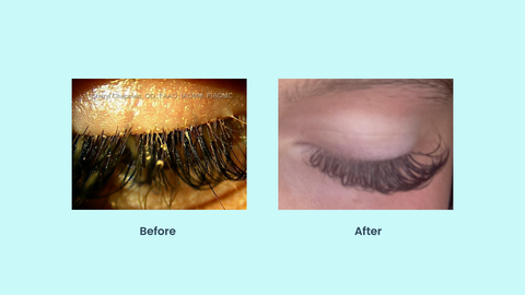 ypochlorous. This protocol has been particularly effective for younger women who play sports and wear false eyelashes.