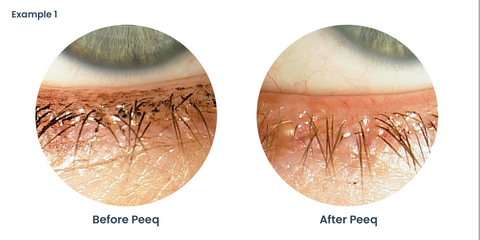 Clinical Examples 1 After Using Peeq Pro - view of eyelid
