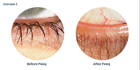 Clinical Example 2 - Before and After using Peeq Pro Eyelid Cleanser