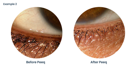 Clinical Example 3 - Before and After using Peeq Pro Eyelid Cleanser