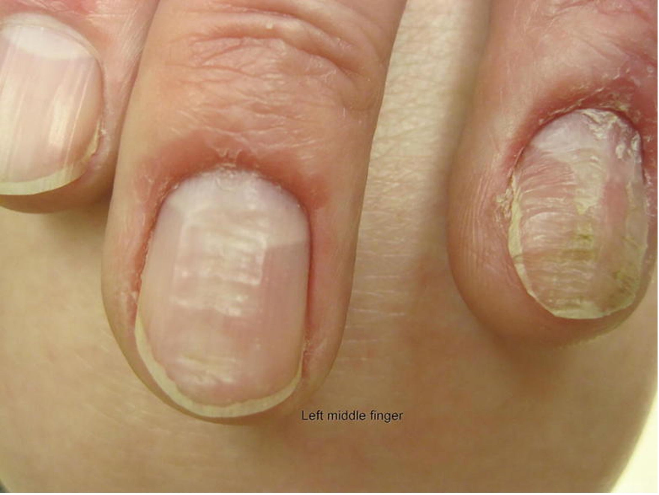 Finger Nails | fungal-nail-laser-dr