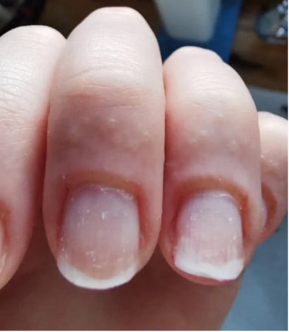 Here is why your fingernails hurt after getting acrylics put on 💅 I n... | Acrylic  Nails | TikTok