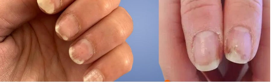 Show your fingernails some TLC. Protect them from fungal infection. -  CHARMS Singapore