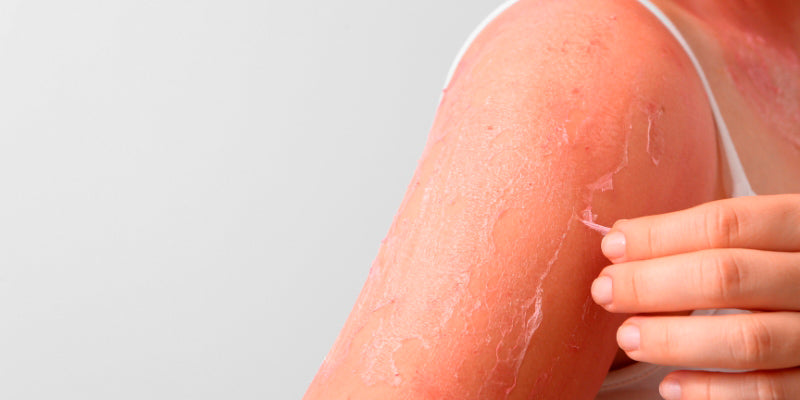 skin peeling is one of the symptoms of sunburn