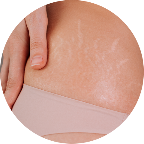Rosehip Helping with Stretch Marks and Scars