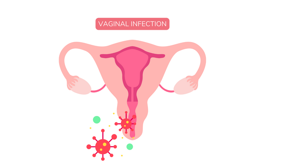 Vaginal Discharge - Causes and Prevention