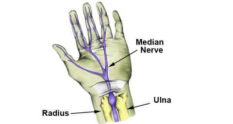 Carpal tunnel syndrome median nerve compression