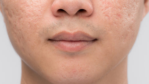 acne scars