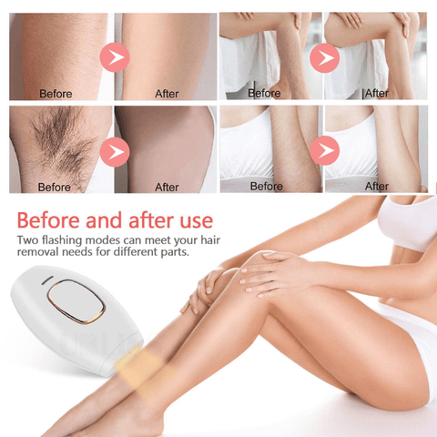 laser hair removal