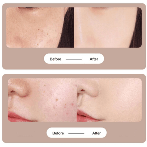 Freckle Removal
