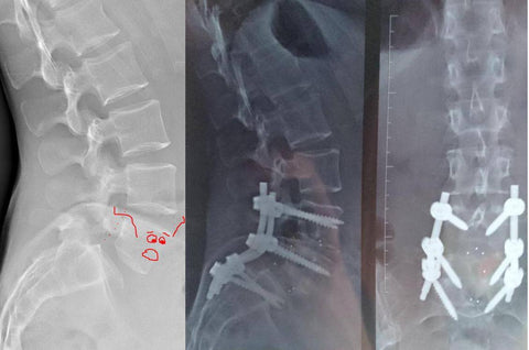 L4-S1 spinal fusion