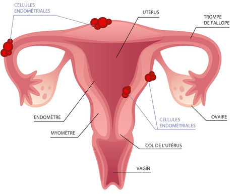 les causes de l'endometriose