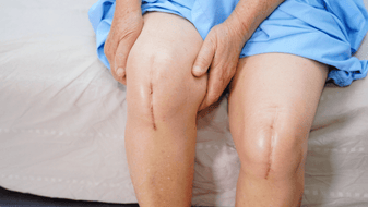 Knee Replacement Blog-min.png__PID:d54db769-fb14-460b-9a7a-441a71cc22ee