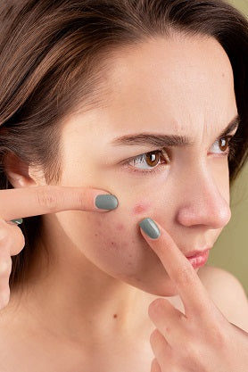clean beauty blog doenças pele acne