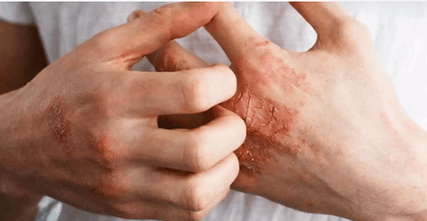 clean beauty blog doenças pele eczema