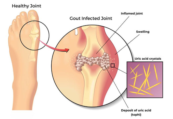 Gout caused by uric acid crystals in the big tow joint