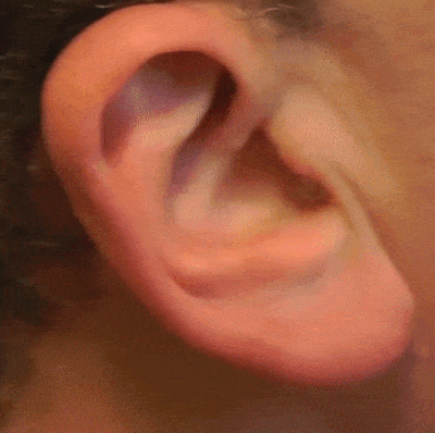 aparelho auditivo invisivel