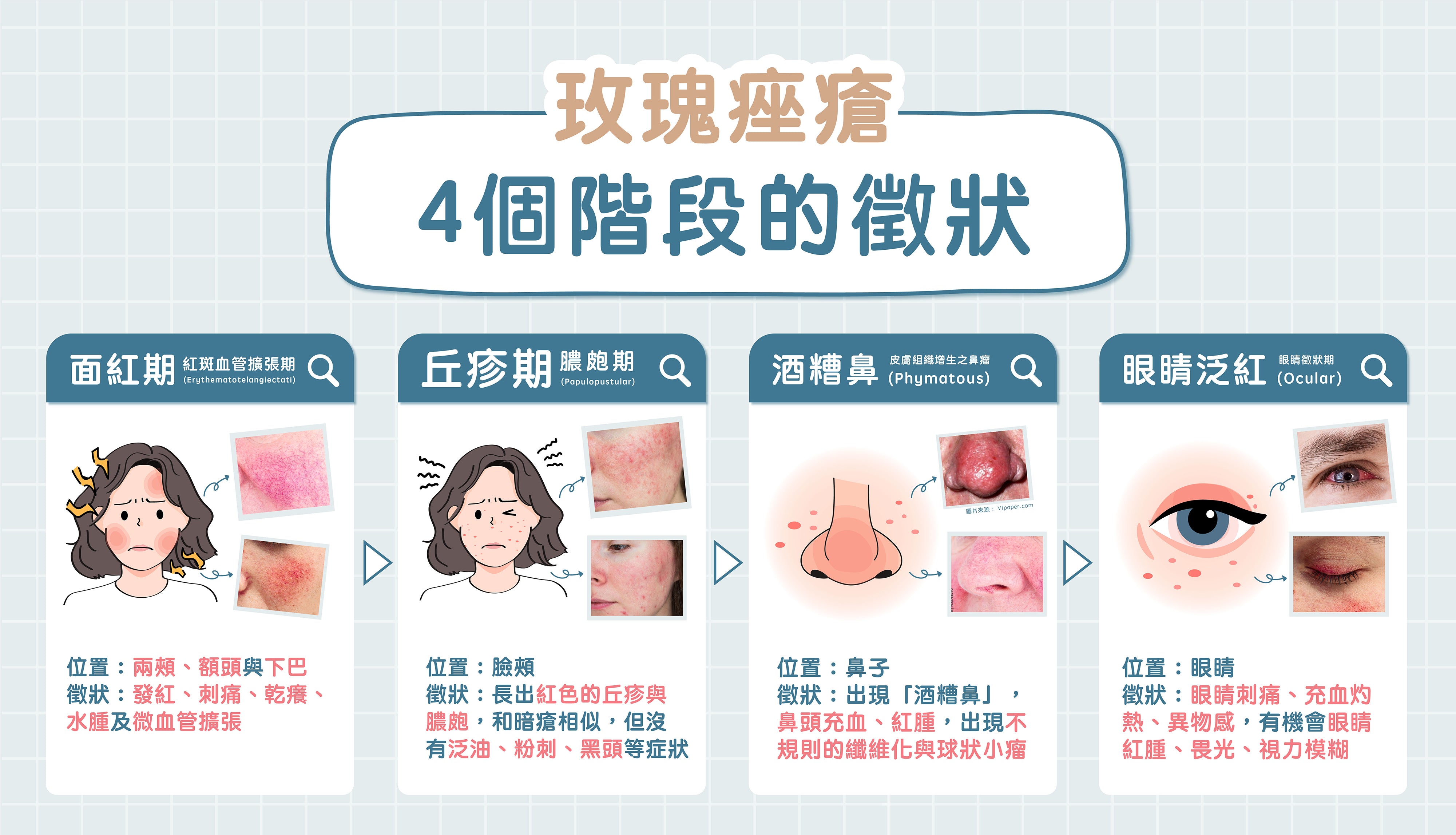 4個玫瑰痤瘡發作時的徵狀與特徵