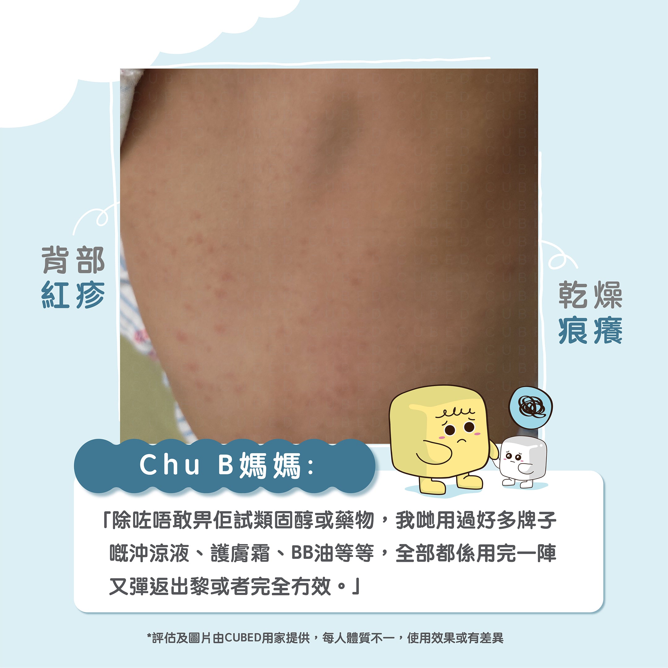 兒童濕疹肌於背部出現紅疹痕癢等徵狀