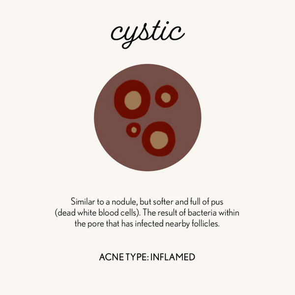 graphic of cystic acne