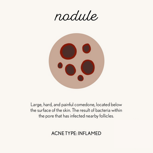 graphic of nodule acne