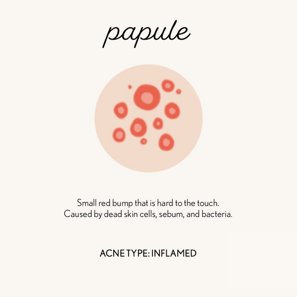 graphic of papule acne