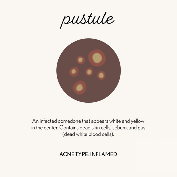 graphic of pustule acne