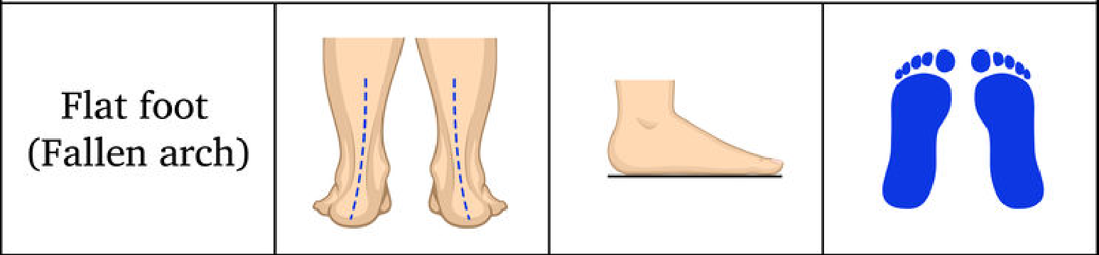 Types of Flat Feet