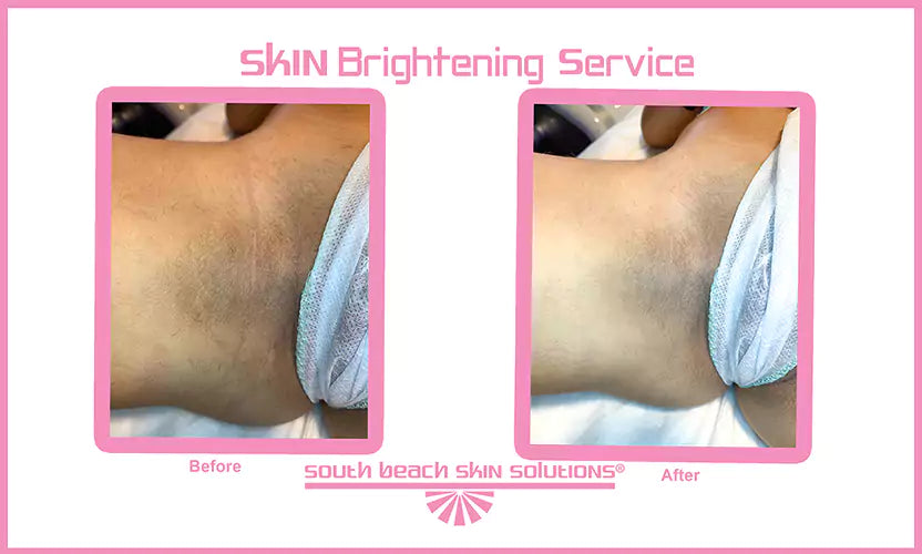 Skin brightening before