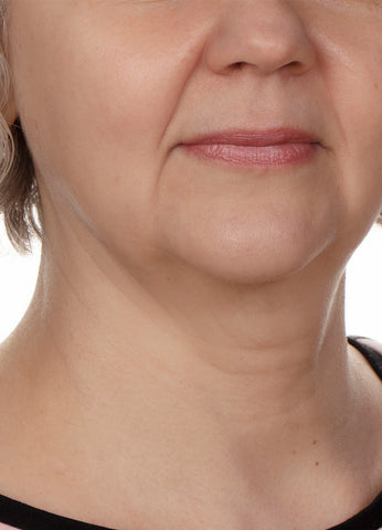 señora de 50 años con cervicoplastia