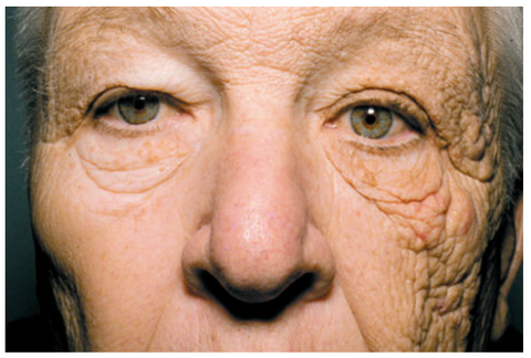 UVA skin ageing acceleration