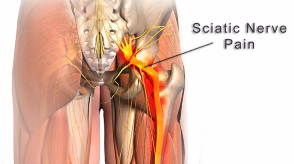 Sciatica Pain During Pregnancy