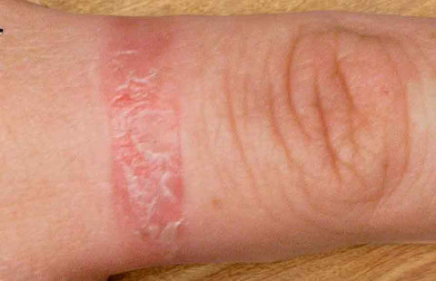 Contact Dermatitis caused by a ring