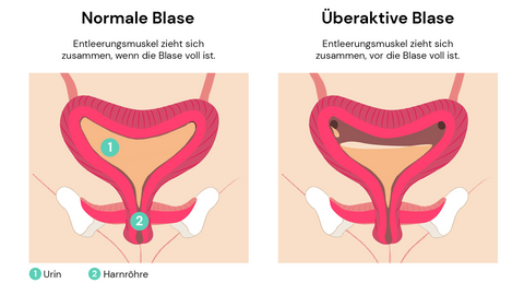 overactive bladder