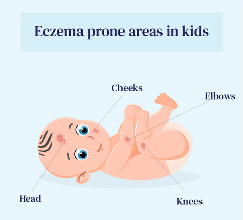 How can parents recognize eczema in babies?