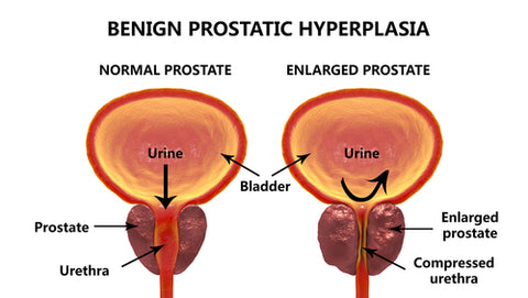 Comparing Healthy and Enlarged Prostate