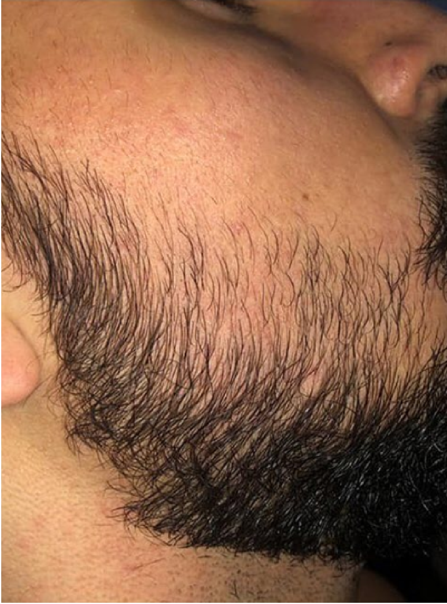 beard growth kit before and after