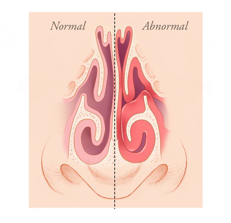 Inflamed nose