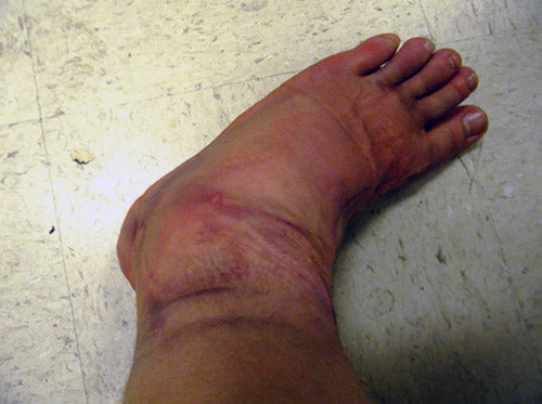 Jujimufu ankle injury, sprained ankle tricking, tricking injury