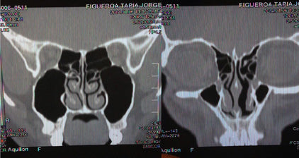 Nose MRI