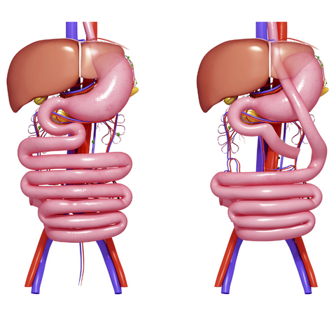 Representative image of the anatomy before and after bypass surgery.