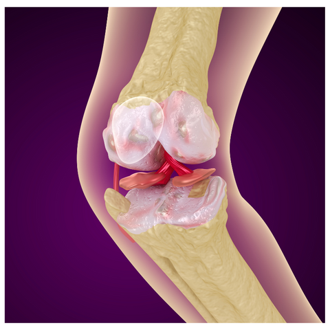 Close-up of a knee joint showing bone deterioration.