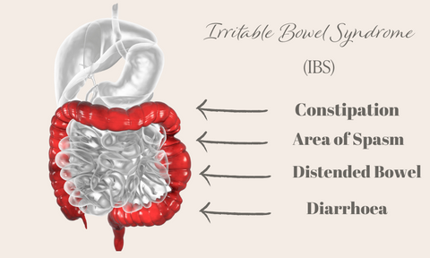 Irritable Bowel Syndrome